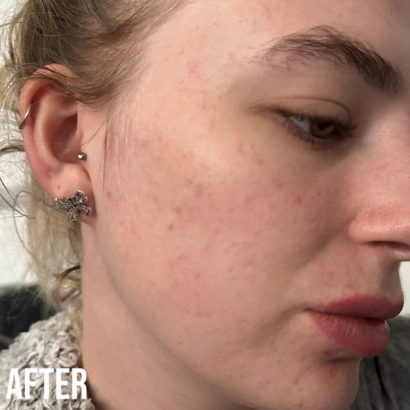 NIB! NIP+ FAB RENEW Blemish gel treatment - Picture 6 of 6